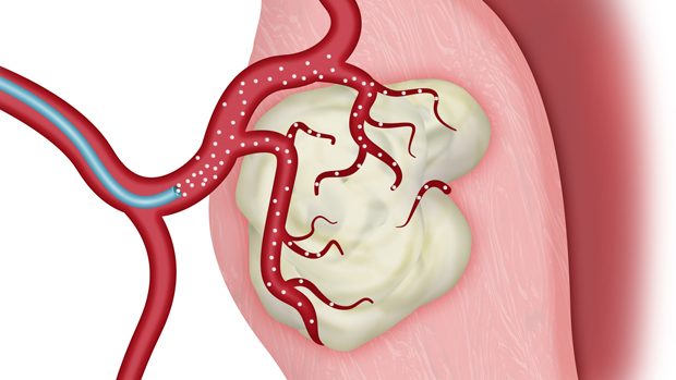 Uterine Fibroid Embolization