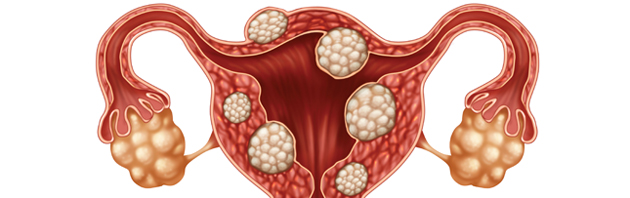 uterine fibroids