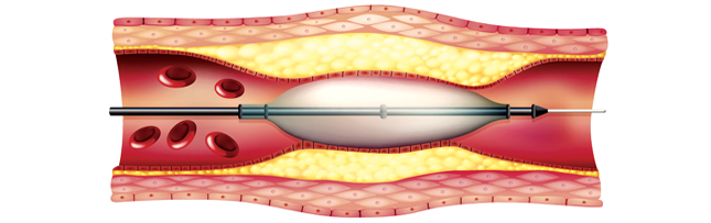 Vascular Disease