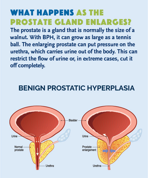 RIS-LVI-PAE-Brochure-Prostate RIS-LVI-PAE-Brochure-Prostate