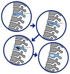 Kyphoplasty Procedure