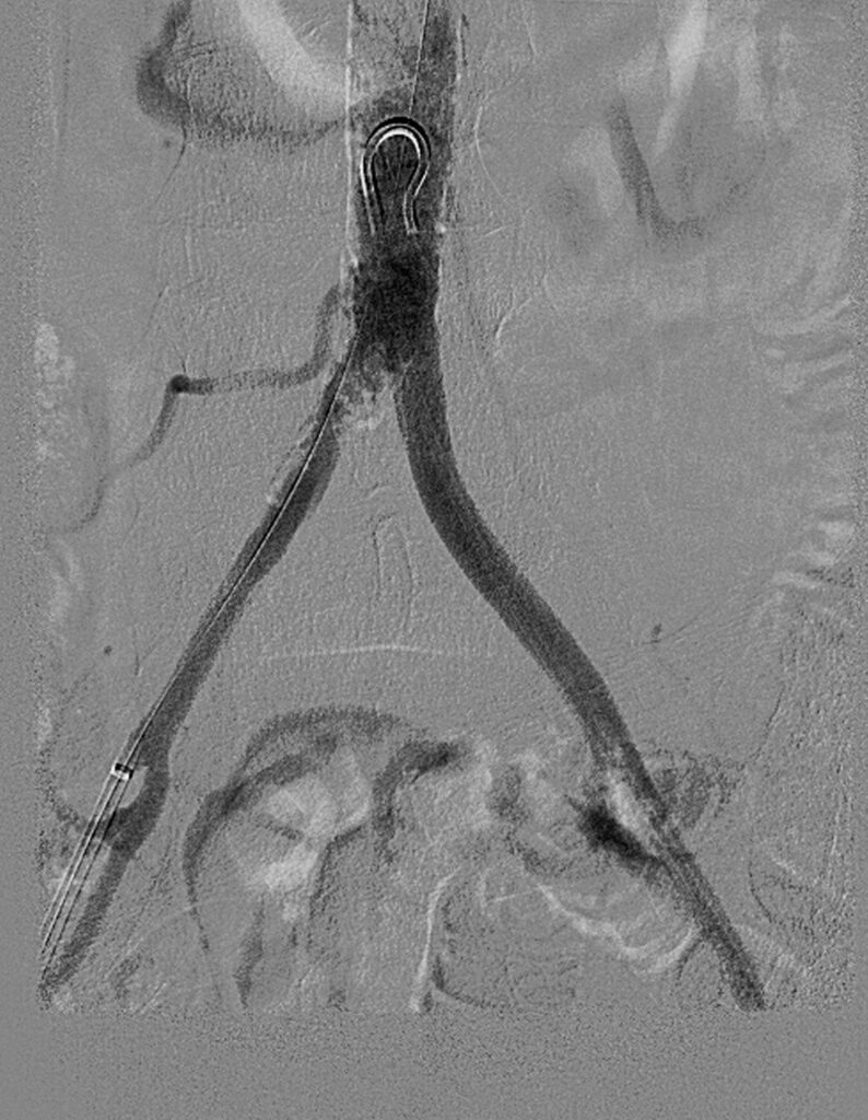 Aorta Post Shockwave