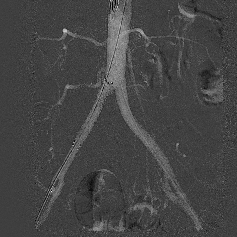 Aorta Post Shockwave and Stent