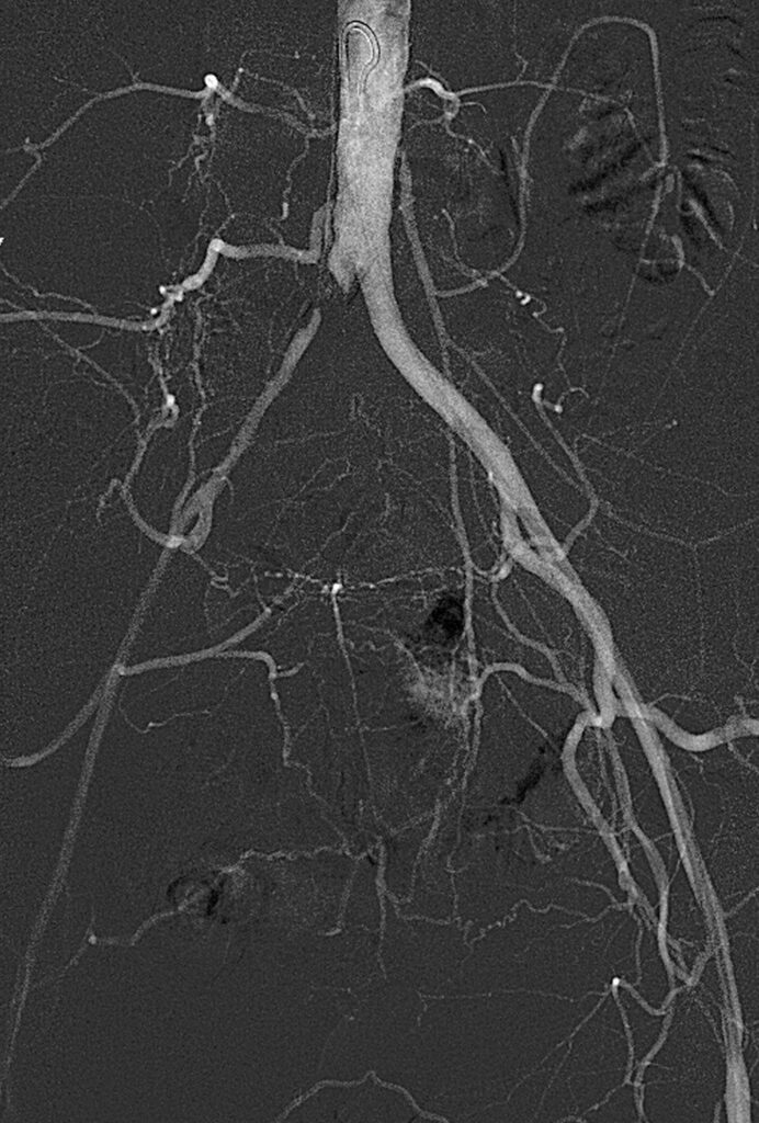 Aorta Pre Shockwave