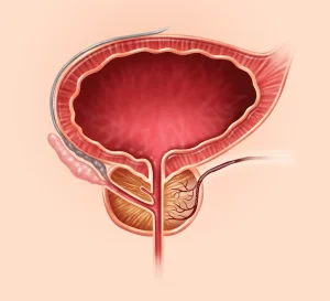 Prostate Artery Embolization