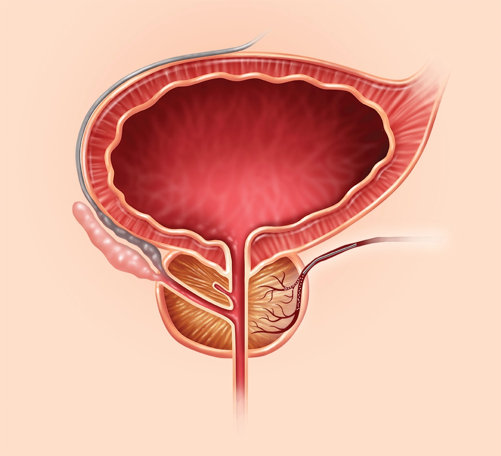 Prostate Artery Embolization