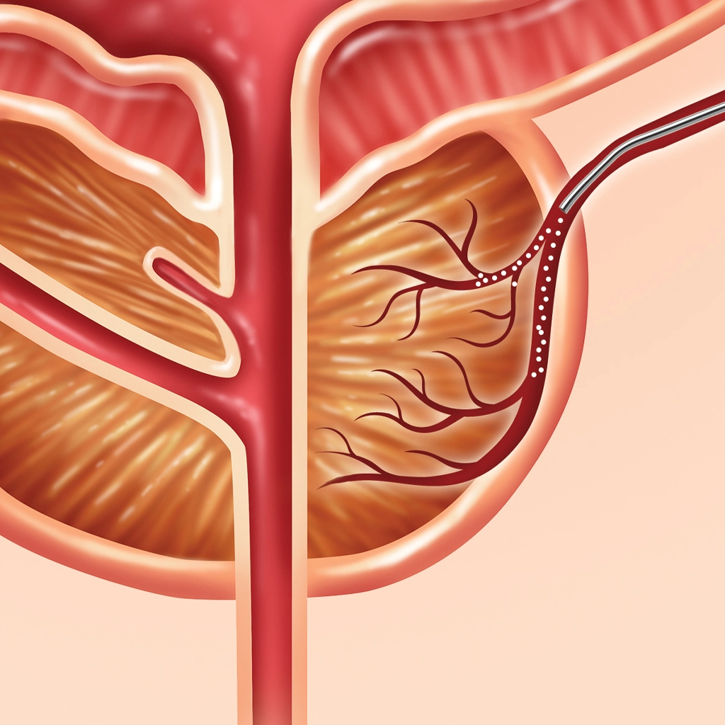 prostate artery embolization